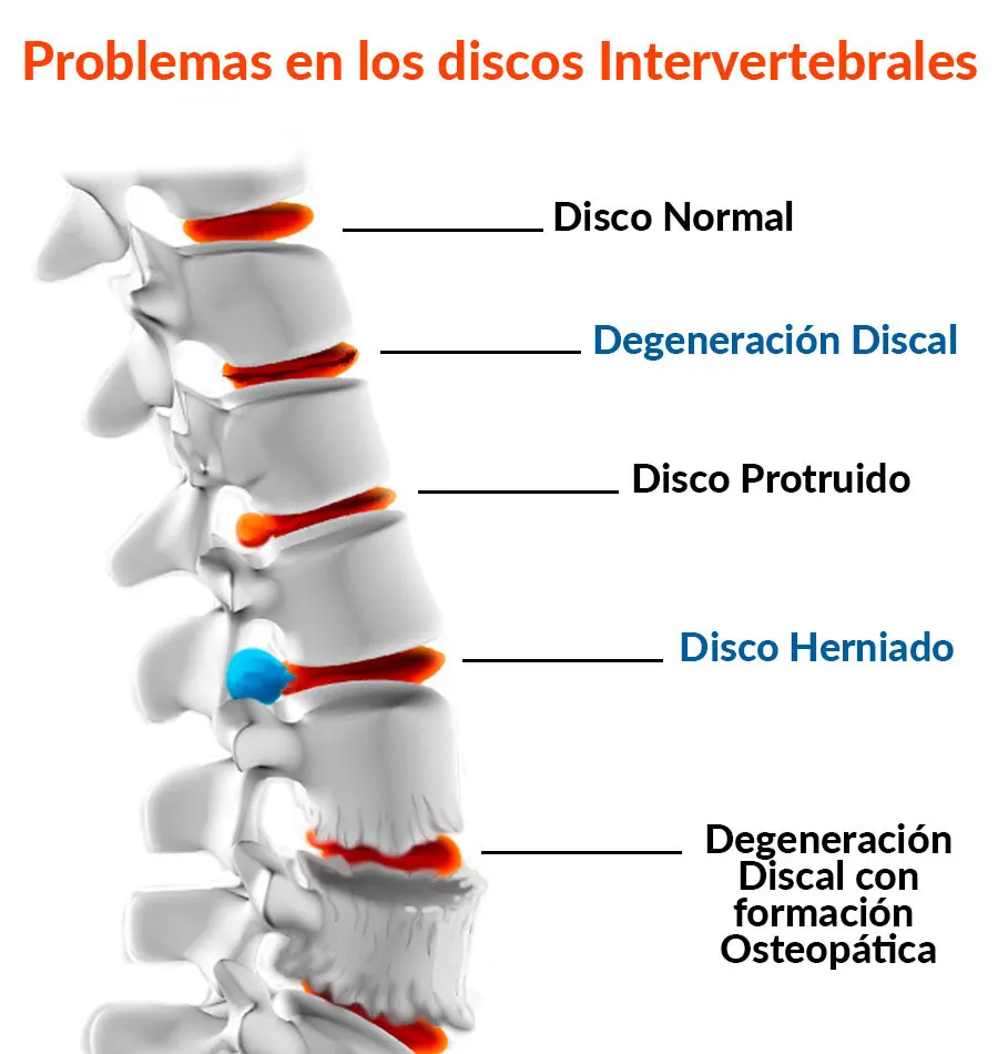 Problemas en los discos intervertebrales